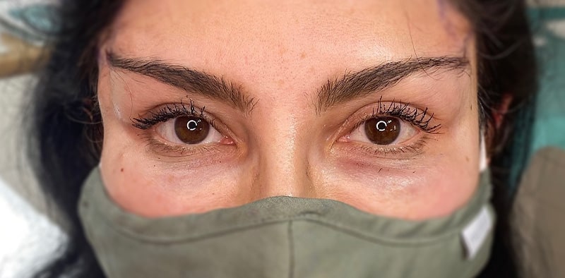 MEDICARE BEAUTY Fadenlifting und Augenbrauenlifting für Fox Eyes