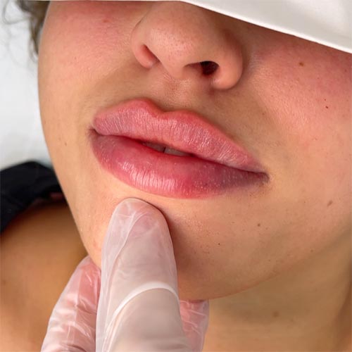 MEDICARE BEAUTY Lippenaufspritzung mit Hyaluron