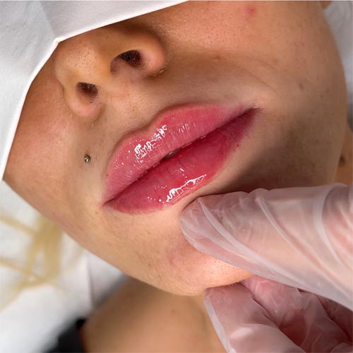 MEDICARE BEAUTY Lippenaufspritzung mit Hyaluron