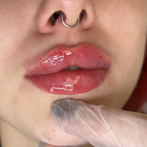 MEDICARE BEAUTY Lippenaufspritzung mit Hyaluron